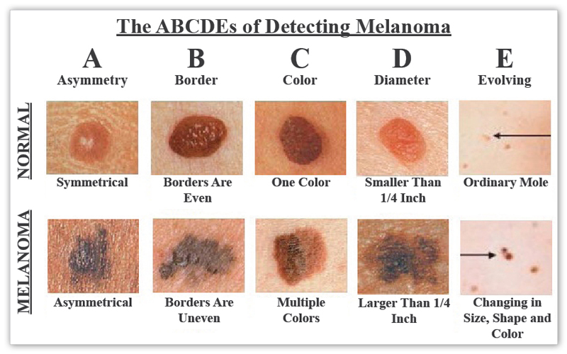 Bőrrák, melanoma jelei