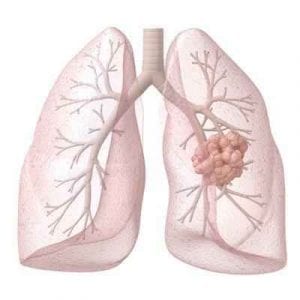 Tüdőrák tünetei