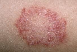 a bőr gombás betegségei