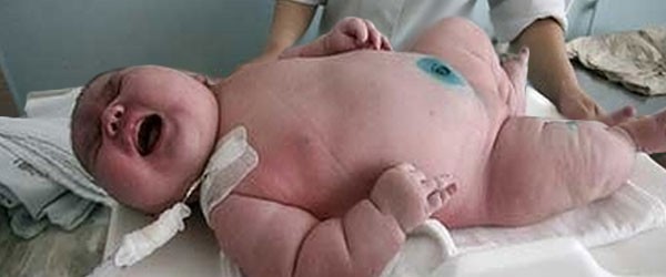 Megdöbbentő! Egy óriás újszülött, - 18 kilós baba született! Megdöbbentő! Egy óriás újszülött, - 18 kilós baba született! 