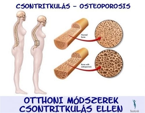 csontritkulas osteoporosis kezelése házilag