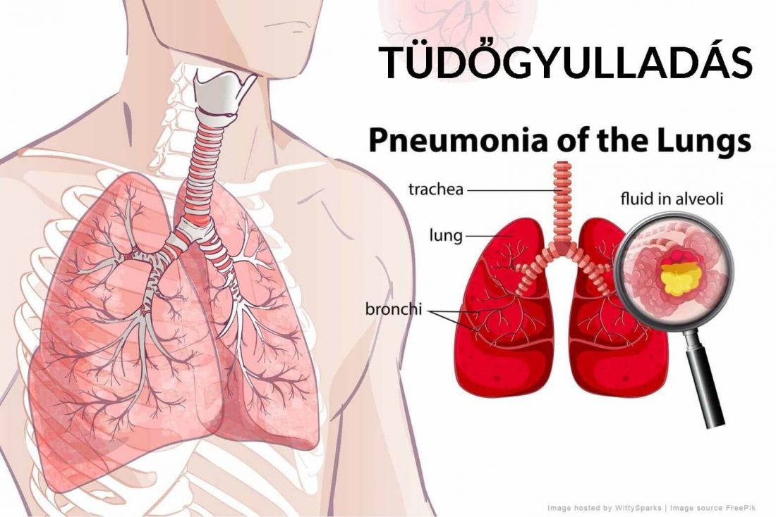 pneumonia kezelése a cukorbetegségben