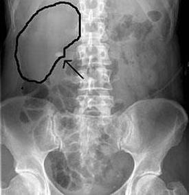 vesekő tünetei veseekő vizsgálat, vesekő diagnosztika